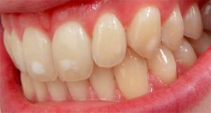 Mild Dental Fluorosis 300x161 1